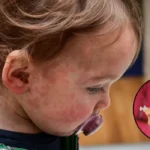 Two children die as measles spreads in London outbreak